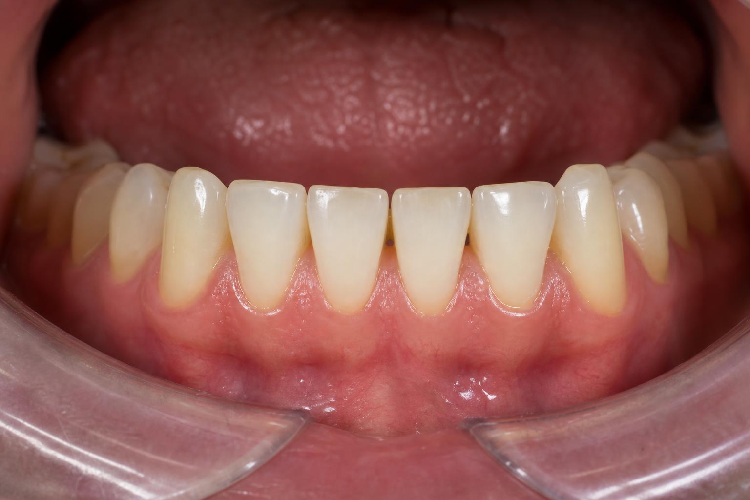 Tooth Cleaning after
