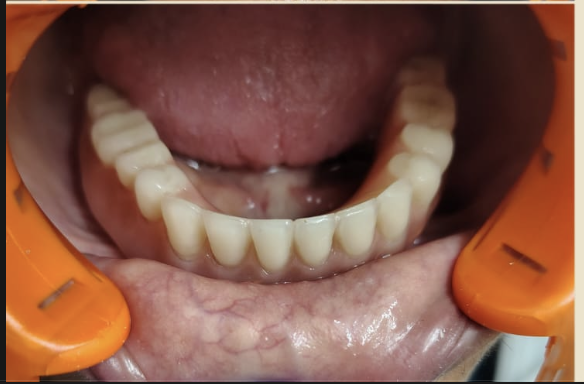 Implant Dentures after