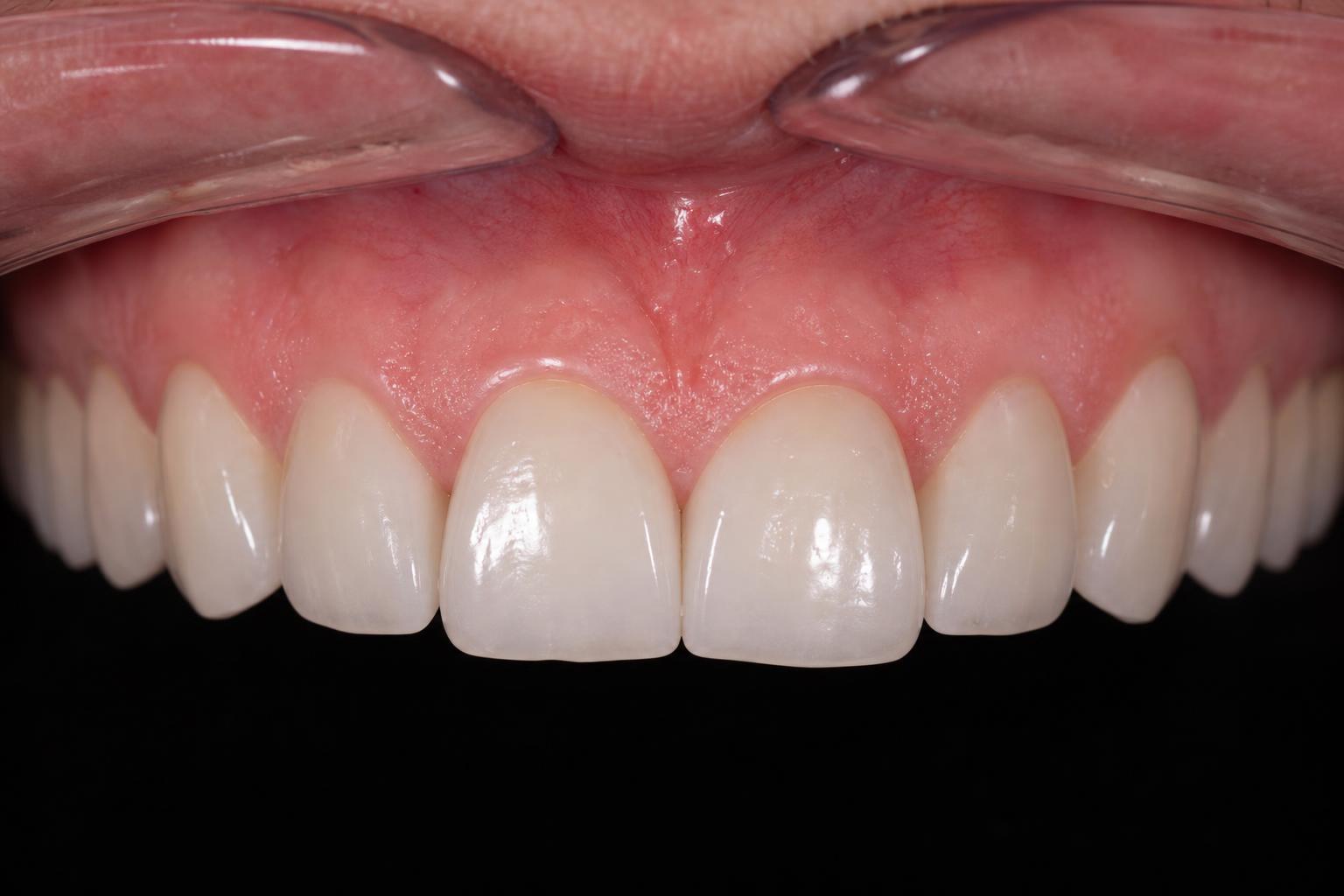 Aesthetic Smile Design after