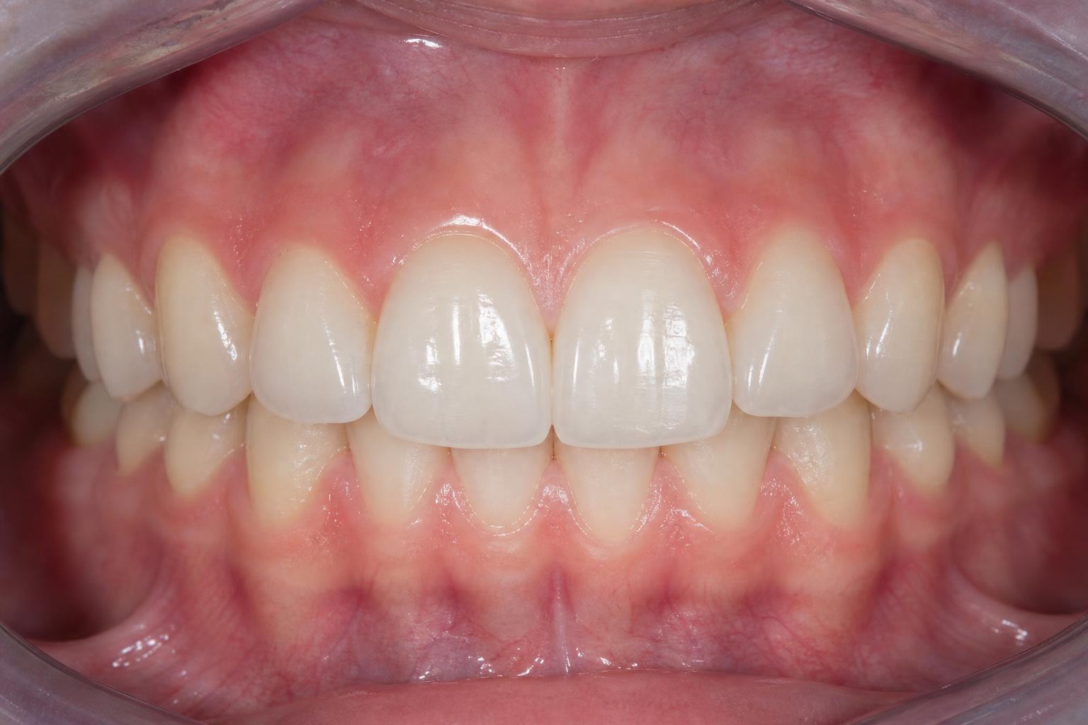Tooth Whitening after